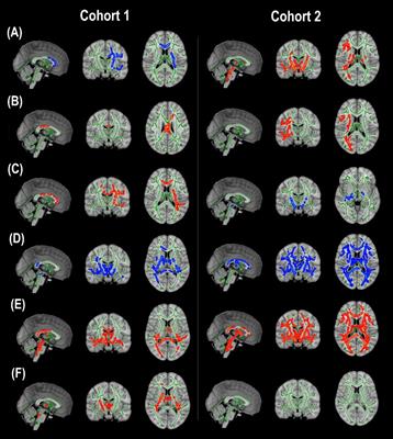 Neuroinflammation and White Matter Alterations in Obesity Assessed by Diffusion Basis Spectrum Imaging